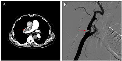 Case Report: Successful Concomitant Pulmonary Thromboendarterectomy and Carotid Endarterectomy